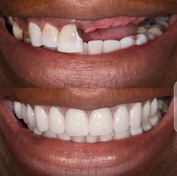 Snap on Smile-Pro : Confort et ajustement parfait