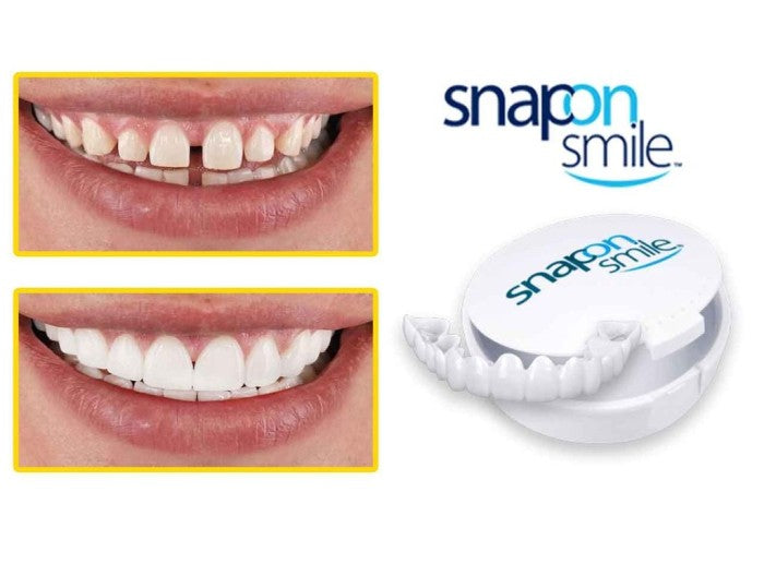Snap on Smile-Pro : Confort et ajustement parfait